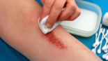 Healing deep wounds faster involves crucial steps: keep the wound clean by gently washing it with mild soap, applying antibiotic ointment, and covering it with a sterile dressing to protect against infection. Ensure proper nutrition, hydration, and adequate rest to support the body's healing process.