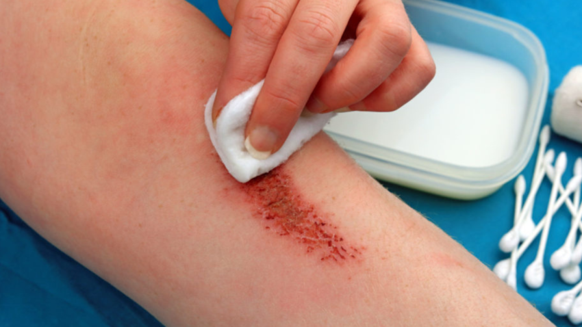 Healing deep wounds faster involves crucial steps: keep the wound clean by gently washing it with mild soap, applying antibiotic ointment, and covering it with a sterile dressing to protect against infection. Ensure proper nutrition, hydration, and adequate rest to support the body's healing process.
